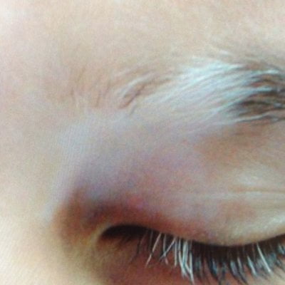 “DRDO hits upon treatment for leucoderma”