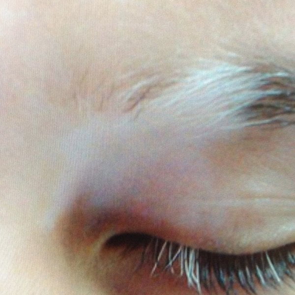 “DRDO hits upon treatment for leucoderma”