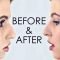 Rhinoplasty - Nose Reshaping - Enhance the Beauty of Your Nose 28