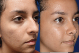 5 Important Facts About Open Rhinoplasty 1