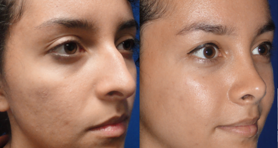 5 Important Facts About Open Rhinoplasty 7