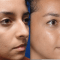 5 Important Facts About Open Rhinoplasty 20
