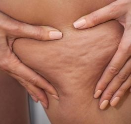 Cellulite: The Myths And The Facts 6