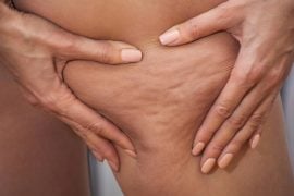 Cellulite: The Myths And The Facts 8