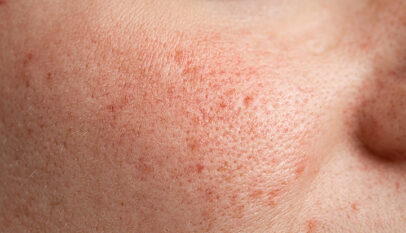 5 have to understand splendor pointers for DRY pores and skin 6