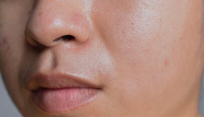 5 need to understand splendor recommendations for OILY skin 12