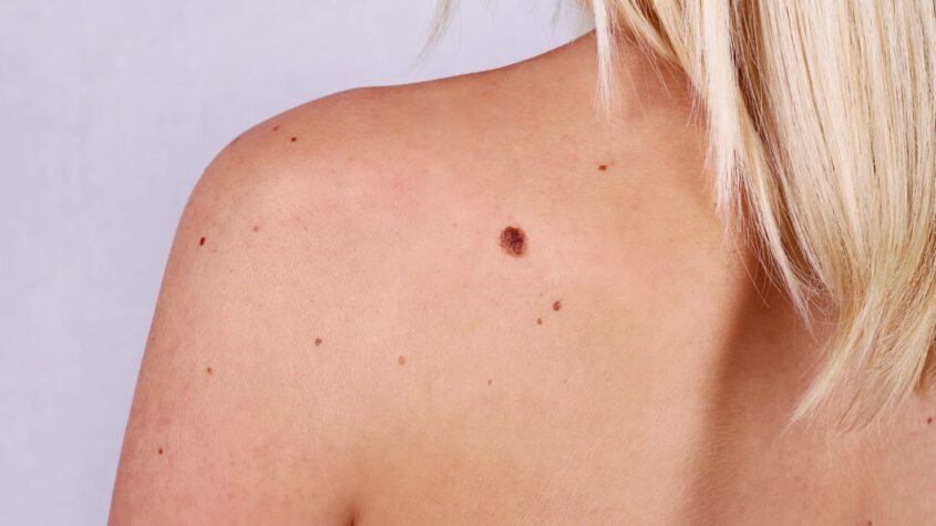 What Are the Different Types of Skin Moles? 1