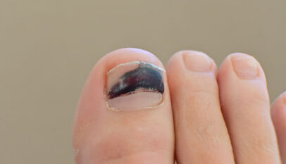 Dealing with a Bruised Toenail: Causes and Treatment 1