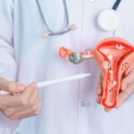 Five weight-reduction plan reforms for battling PCOS 127