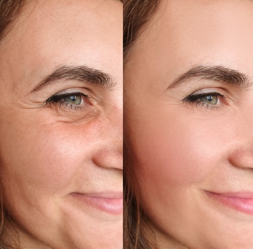 No Needles, No Stress: Skin Tightening for Everyday Beauty 5