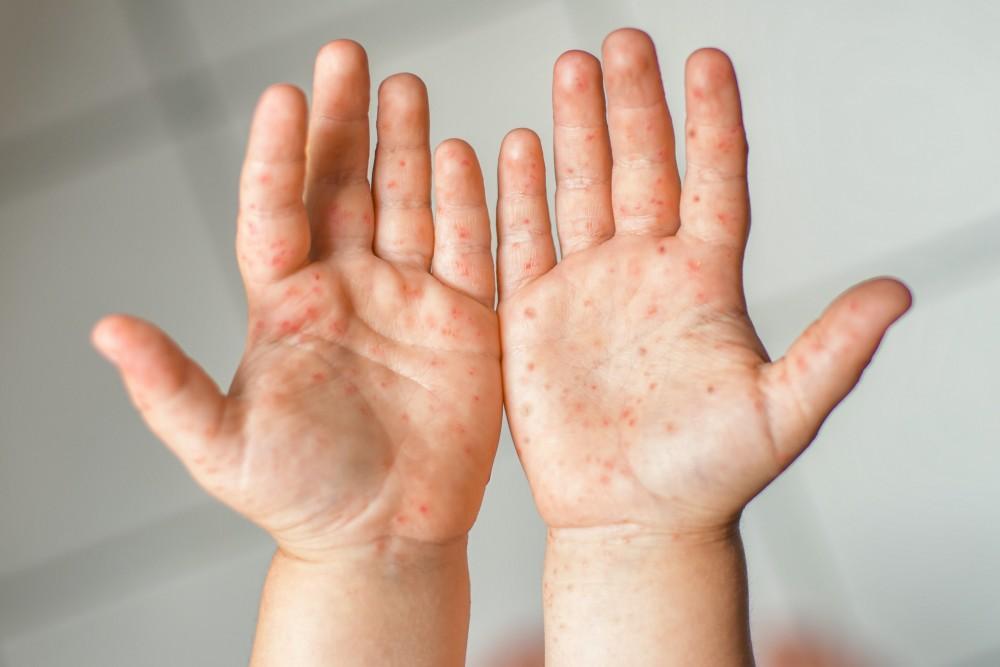 Understanding the Differences between Impetigo and Hand Foot Mouth