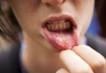 How to Prevent Lip Cancer in the Future