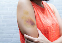Bruises: Symptoms and Treatment