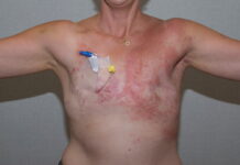 Inflammatory Breast Cancer – The Importance of Early Detection