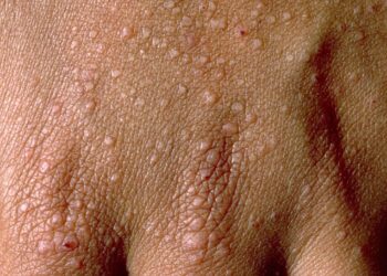 Follicular Eczema: Understanding the Causes, Symptoms, and Treatment Options