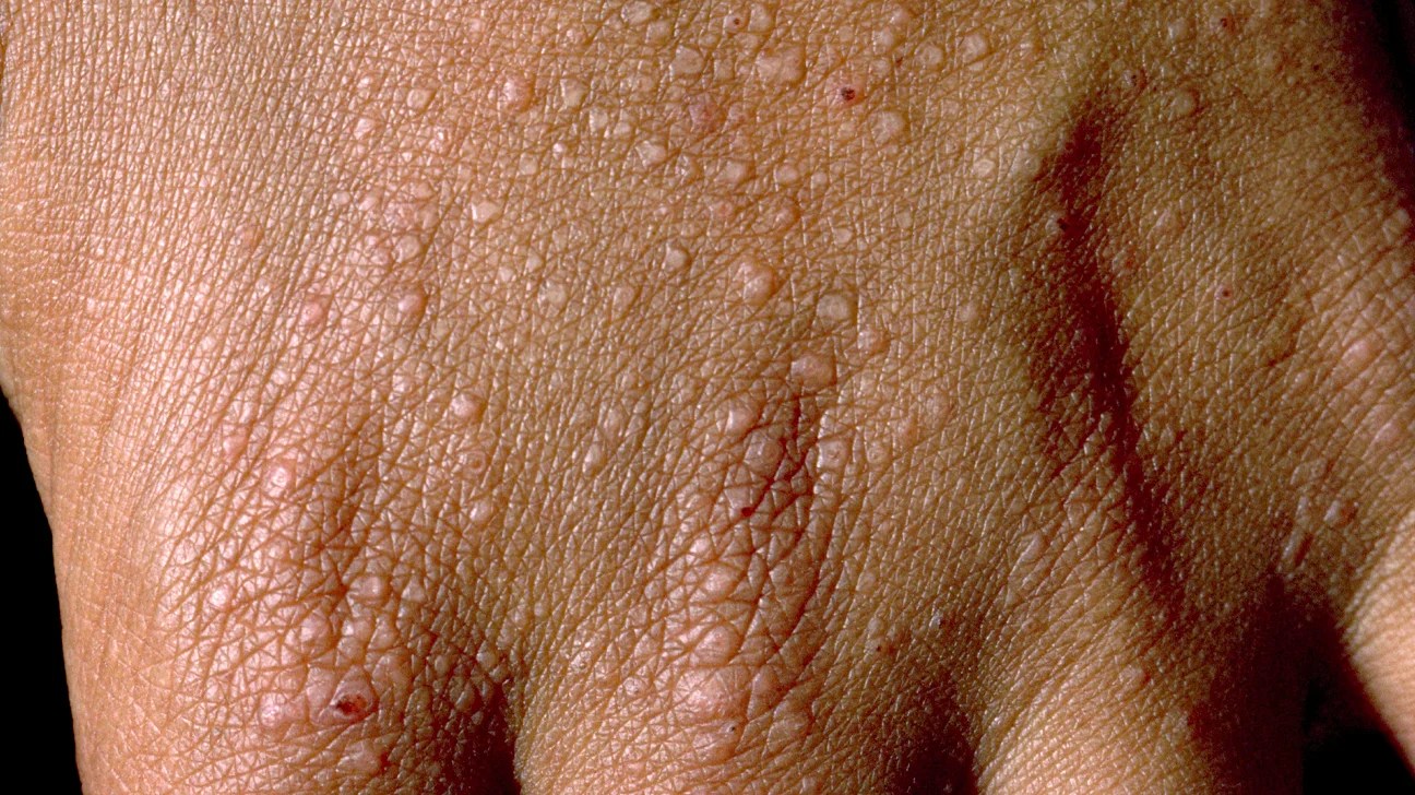 Follicular Eczema Understanding the Causes, Symptoms, and Treatment