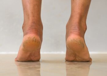 This DIY home cure for cracked heels works like an attraction!