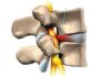 Lumbar Disc Prolapse Rubik Lifestyle 30