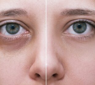 Revitalize Your Look with Undereye Filler 14