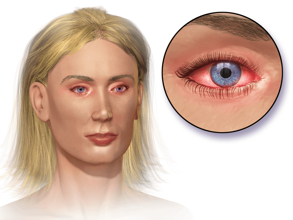 Bloodshot Eyes Treatment 2