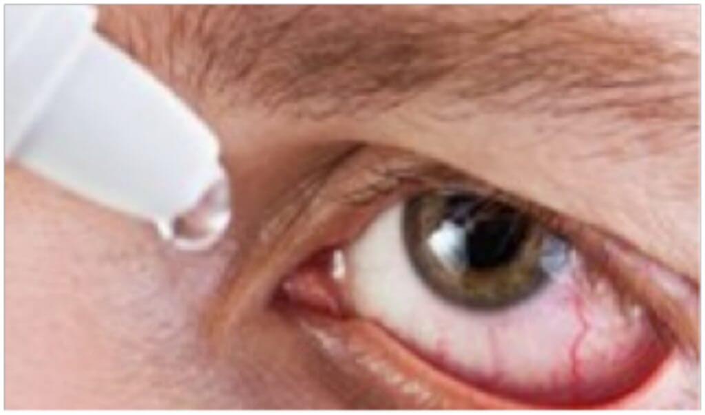 Dry Eyes After Lasik Eye Surgery 3
