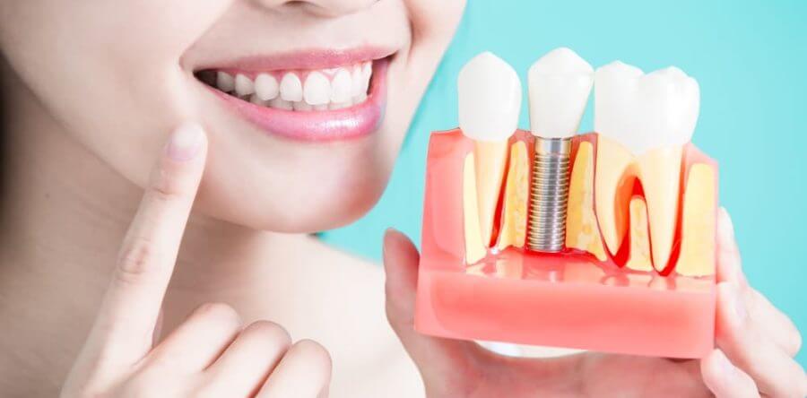 Health Benefits of Dental Implants 1