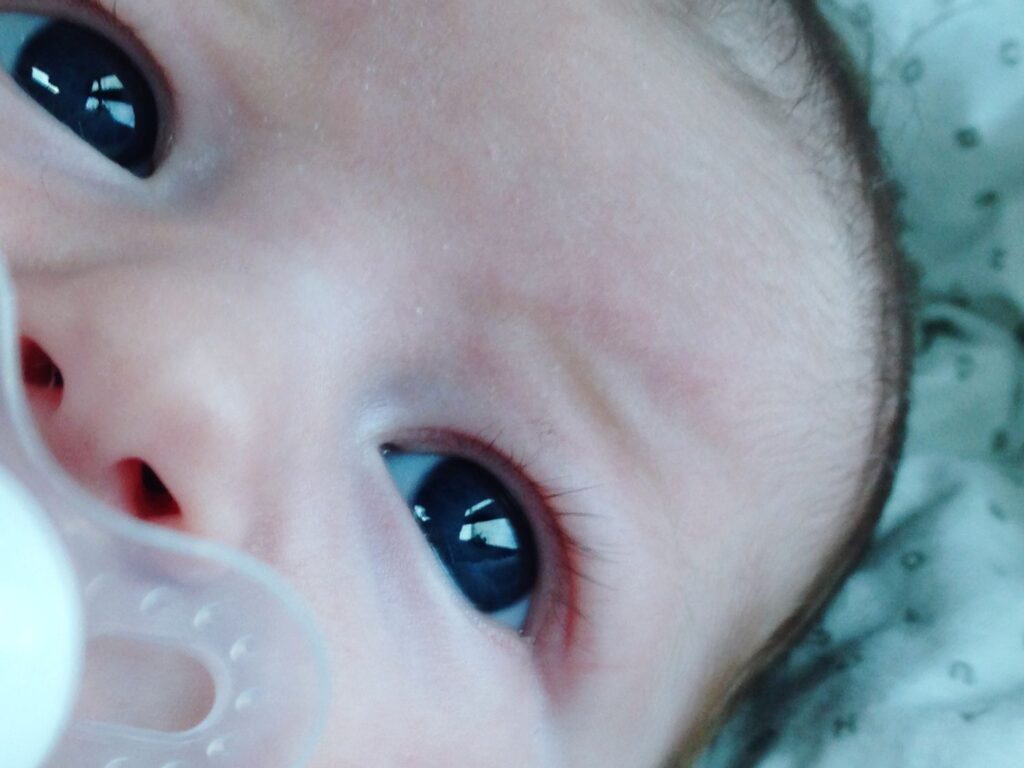Baby Eye Infection 1