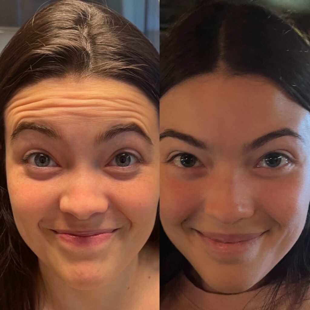Baby Botox: The New Trend in Anti-Aging Treatments 1