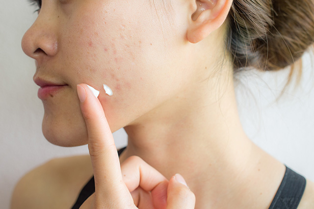 Effective Acne Treatments with Benzoyl Peroxide 1