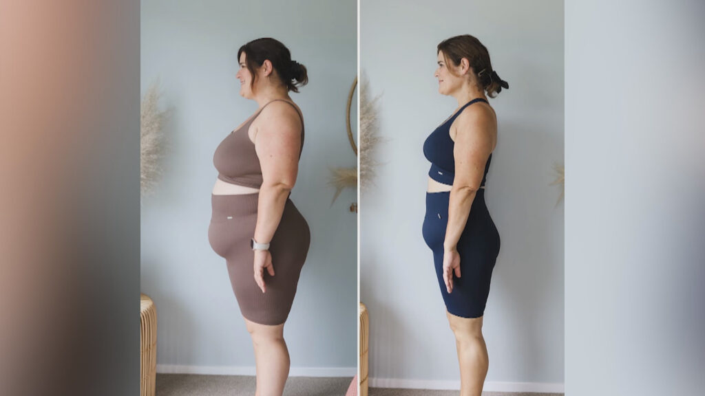 How Effective Is Weight Loss Surgery? 3