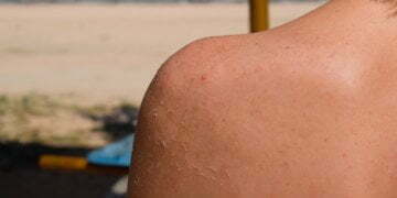 The Best Treatments for Sunburn, According to Dermatologists