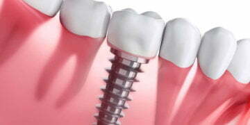 The Dental Implant Pros: More than a Pretty Face
