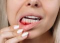 Essential Tips For Preventing Gum Disease