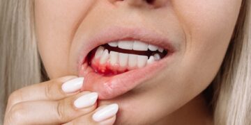 Essential Tips For Preventing Gum Disease
