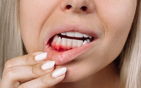 Essential Tips For Preventing Gum Disease