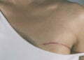 Tells You About Having Breast Cancer