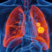 ‘I became stunned after they stated it turned into lung cancer’