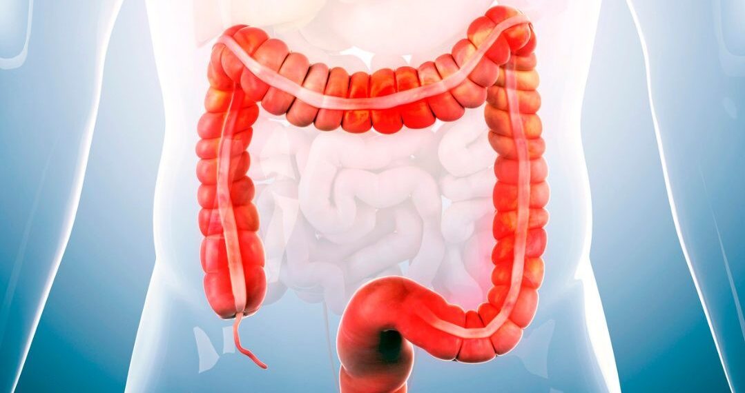 Irritable Bowel Syndrome