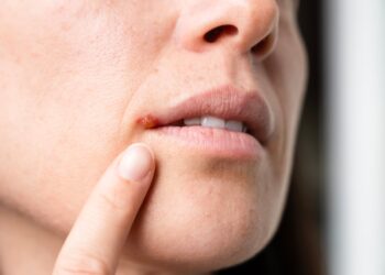 Cold Sores Home Remedies – What Causes Them?