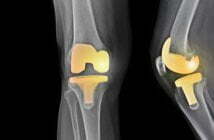 Knee substitute: Lifestyles converting or a sadness? 2