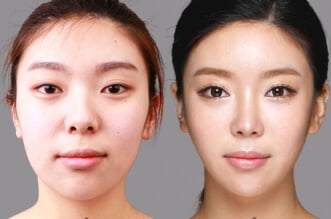 Top 4 Things to Consider Before Having Rhinoplasty 25