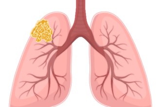 4 Blood Tests To Detect Mesothelioma 27