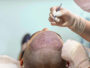 Frequently Asked Questions Regarding Hair Loss and FUE Hair Transplant 4