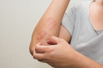 All about food allergy rashes 7