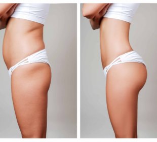 Tips For Maintaining Your Liposuction Results 53