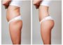 Tips For Maintaining Your Liposuction Results 50
