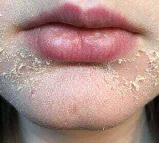 How can I treat dry flaky skin under my beard and moustache area? 57