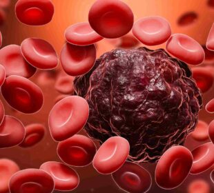 What is Blood Cancer High White Cell Count? 62