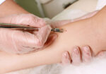 Skin Cancer Treatment - What Are The Best Treatments? 51