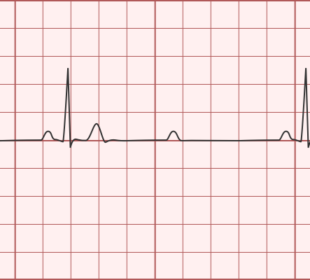 Mobitz Type 2 - How it Works and How You Can Use It 51